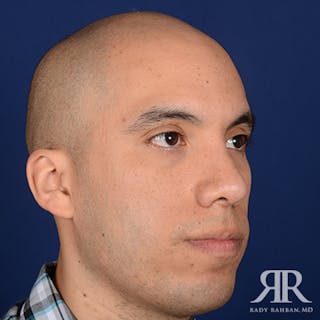 Male Rhinoplasty Before & After Gallery - Patient 281326 - Image 4