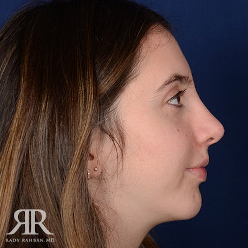 Female Rhinoplasty Before & After Gallery - Patient 116917 - Image 6