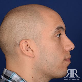 Male Rhinoplasty Before & After Gallery - Patient 281326 - Image 6
