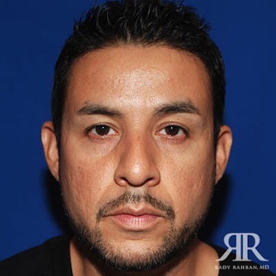 Male Rhinoplasty Before & After Gallery - Patient 257061 - Image 1
