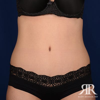 Tummy Tuck Before & After Gallery - Patient 186505 - Image 2
