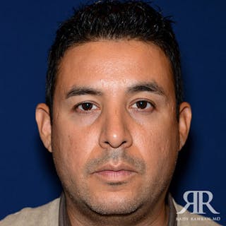 Male Rhinoplasty Before & After Gallery - Patient 257061 - Image 2