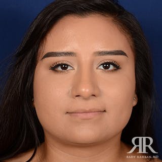 Female Rhinoplasty Before & After Gallery - Patient 368775 - Image 2