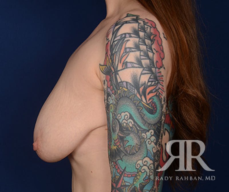 Breast Lift Before & After Gallery - Patient 291315 - Image 5
