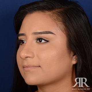 Female Rhinoplasty Before & After Gallery - Patient 368775 - Image 4