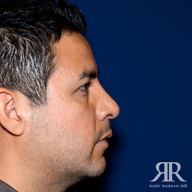 Male Rhinoplasty Before & After Gallery - Patient 257061 - Image 6