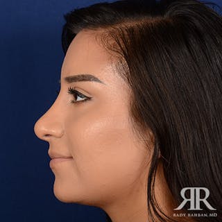 Female Rhinoplasty Before & After Gallery - Patient 368775 - Image 6