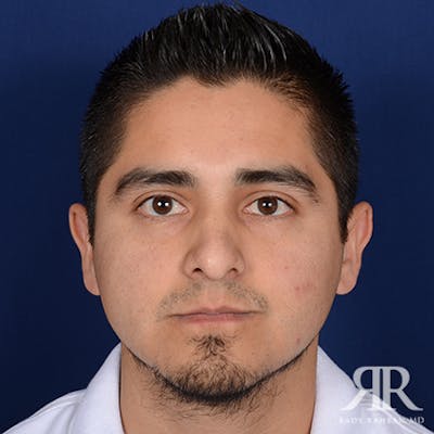 Male Rhinoplasty Before & After Gallery - Patient 346426 - Image 1