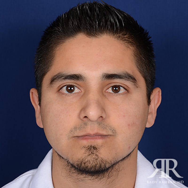 Male Rhinoplasty Before & After Gallery - Patient 346426 - Image 1