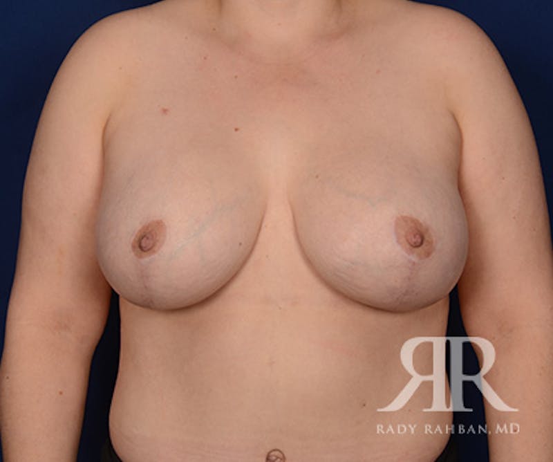 Breast Lift Before & After Gallery - Patient 352152 - Image 2