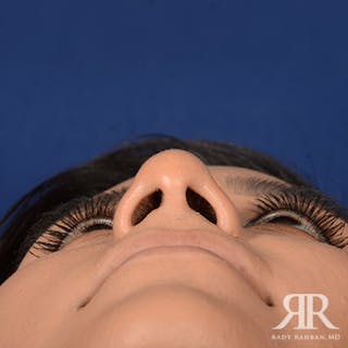 Female Rhinoplasty Before & After Gallery - Patient 368775 - Image 8