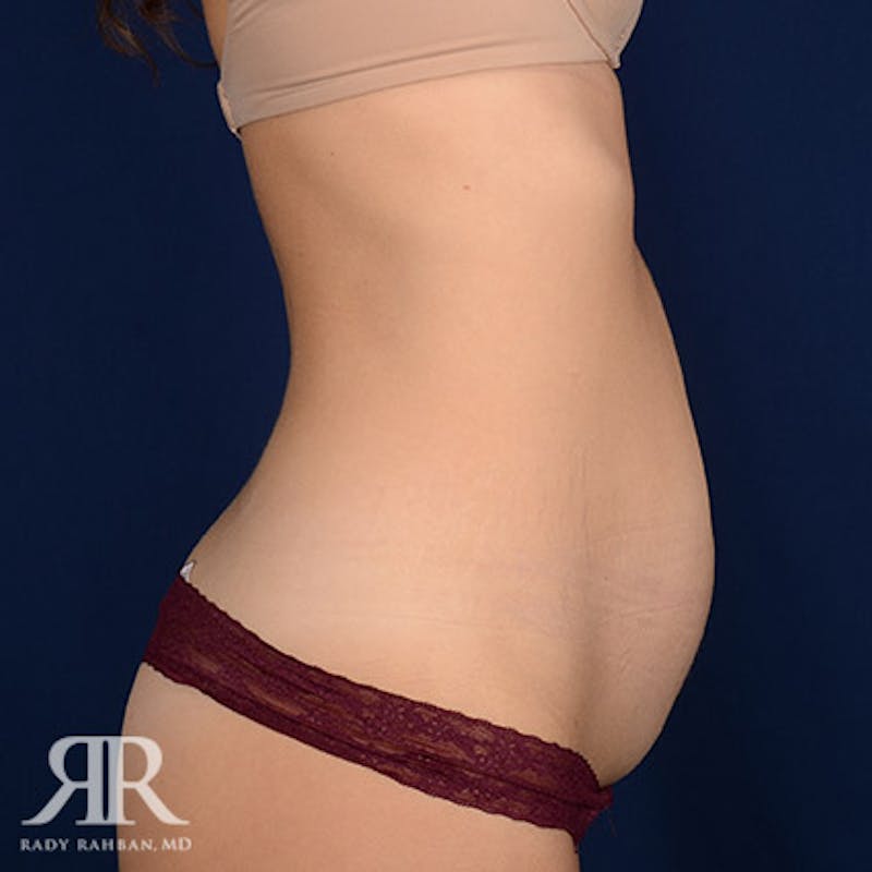 Tummy Tuck Before & After Gallery - Patient 330815 - Image 5