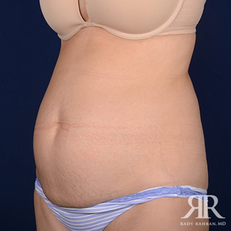 Tummy Tuck Before & After Gallery - Patient 297565 - Image 3