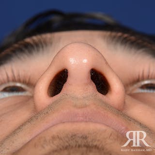 Male Rhinoplasty Before & After Gallery - Patient 346426 - Image 8