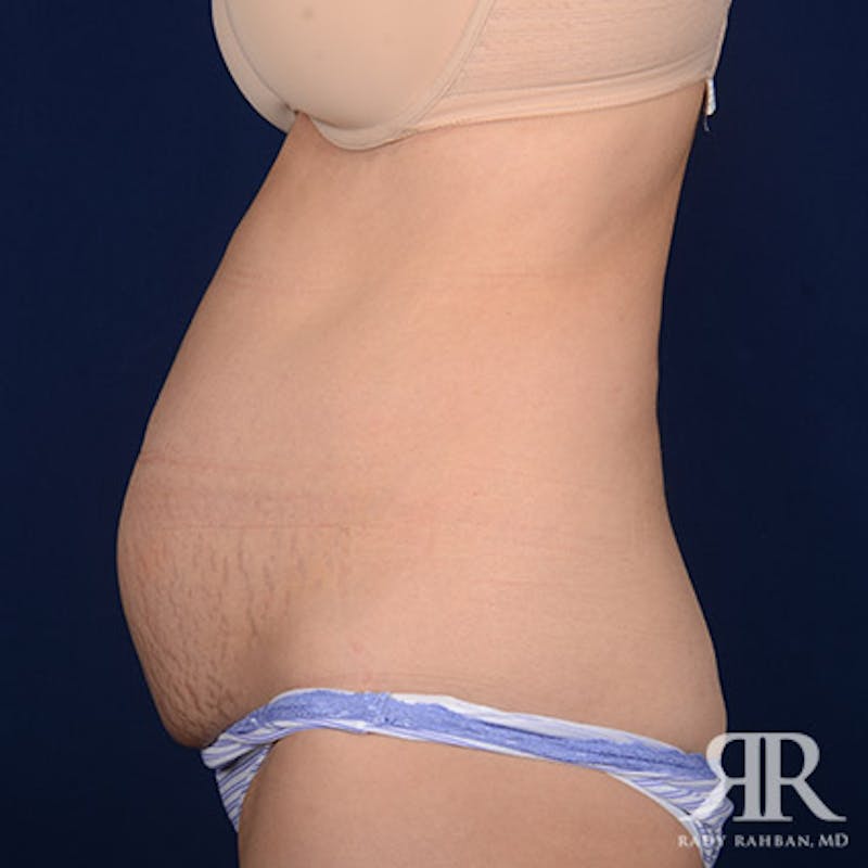Tummy Tuck Before & After Gallery - Patient 297565 - Image 5