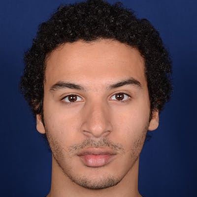 Male Rhinoplasty Before & After Gallery - Patient 291854 - Image 1