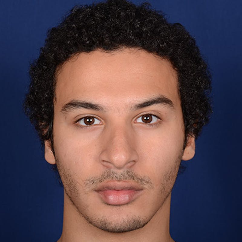 Male Rhinoplasty Before & After Gallery - Patient 291854 - Image 1
