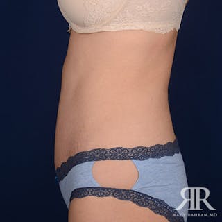 Tummy Tuck Before & After Gallery - Patient 297565 - Image 6