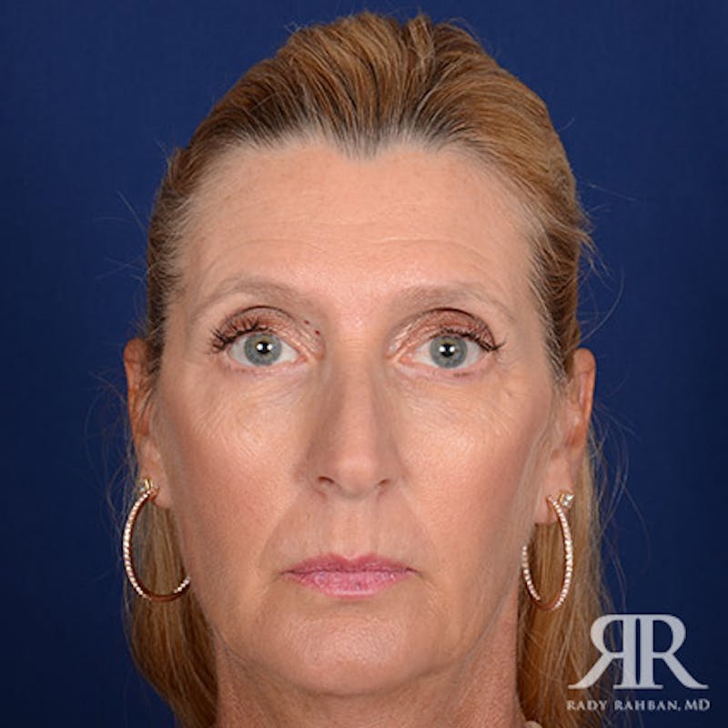 Female Rhinoplasty Before & After Gallery - Patient 338985 - Image 1