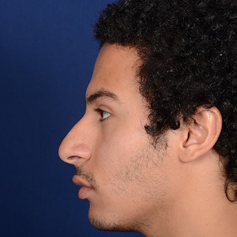Male Rhinoplasty Before & After Gallery - Patient 291854 - Image 3