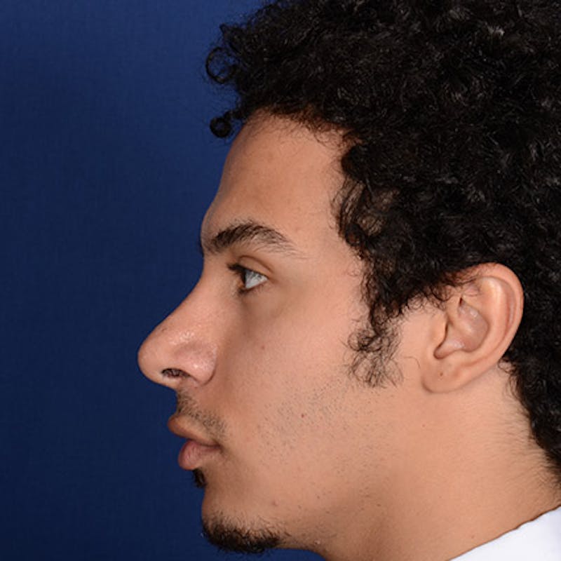 Male Rhinoplasty Before & After Gallery - Patient 291854 - Image 4