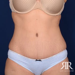 Tummy Tuck Before & After Gallery - Patient 335324 - Image 2
