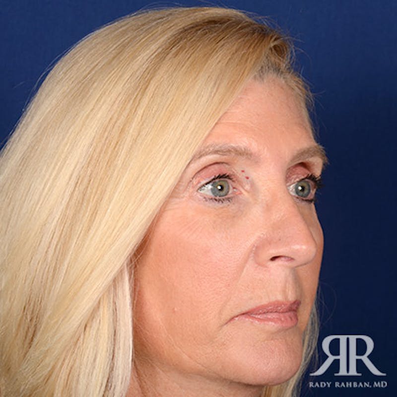Female Rhinoplasty Before & After Gallery - Patient 338985 - Image 4