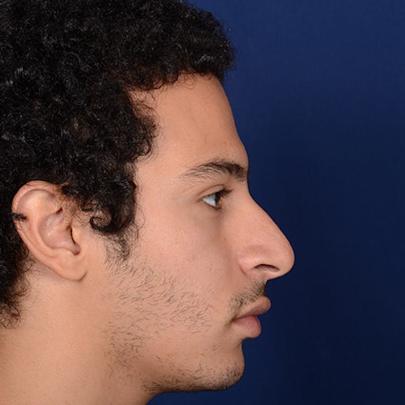 Male Rhinoplasty Before & After Gallery - Patient 291854 - Image 5