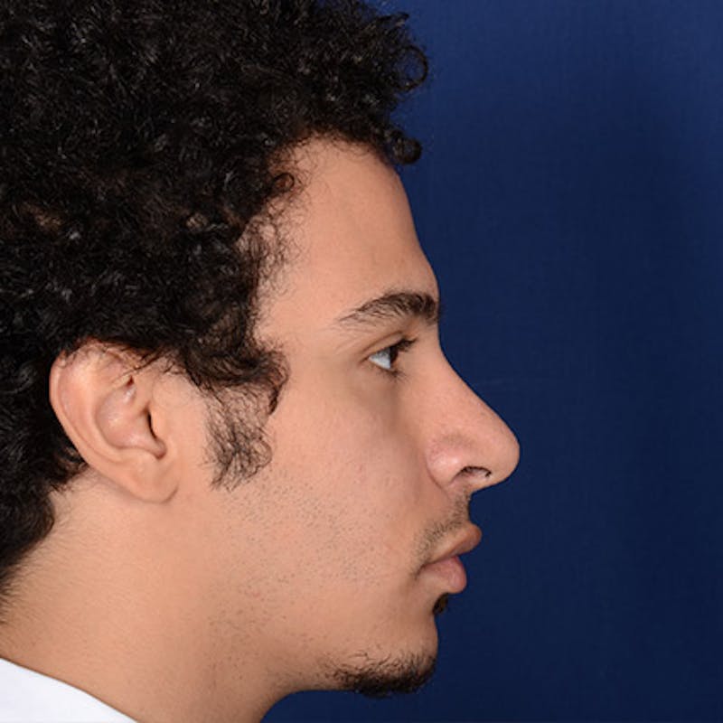 Male Rhinoplasty Before & After Gallery - Patient 291854 - Image 6
