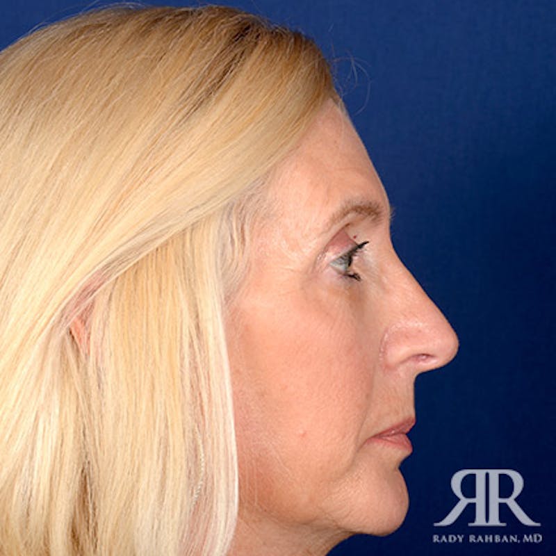 Female Rhinoplasty Before & After Gallery - Patient 338985 - Image 6
