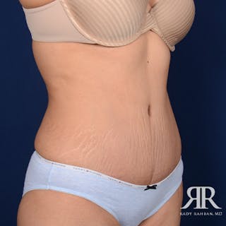 Tummy Tuck Before & After Gallery - Patient 335324 - Image 4