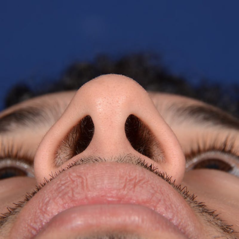 Male Rhinoplasty Before & After Gallery - Patient 291854 - Image 7