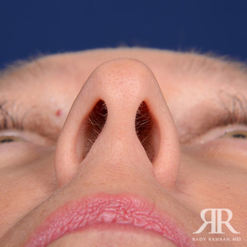 Female Rhinoplasty Before & After Gallery - Patient 338985 - Image 7