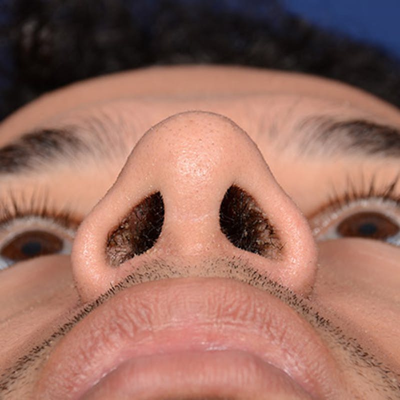 Male Rhinoplasty Before & After Gallery - Patient 291854 - Image 8