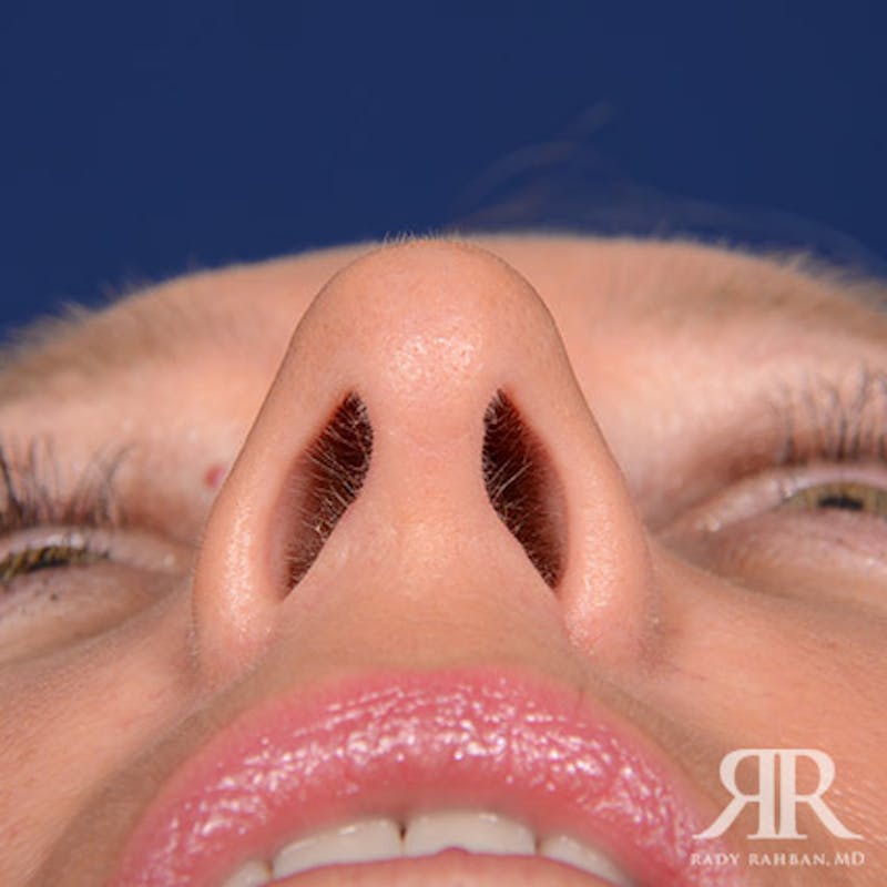 Female Rhinoplasty Before & After Gallery - Patient 338985 - Image 8