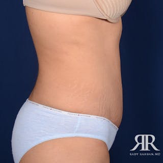 Tummy Tuck Before & After Gallery - Patient 335324 - Image 6