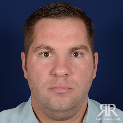 Male Rhinoplasty Before & After Gallery - Patient 320524 - Image 1