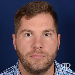 Male Rhinoplasty Before & After Gallery - Patient 320524 - Image 2