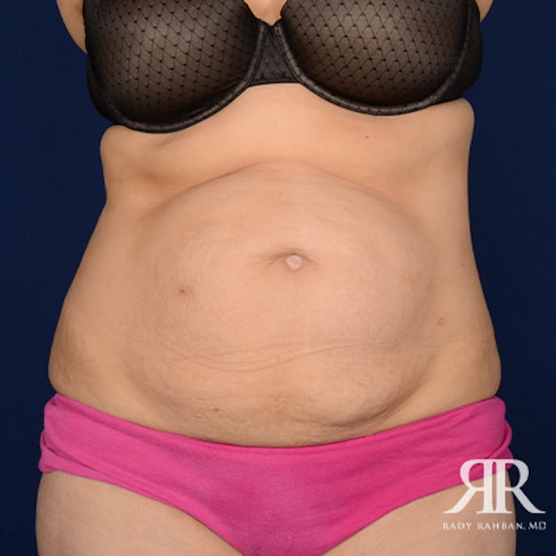 Tummy Tuck Before & After Gallery - Patient 210096 - Image 1