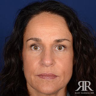 Female Rhinoplasty Before & After Gallery - Patient 205526 - Image 2
