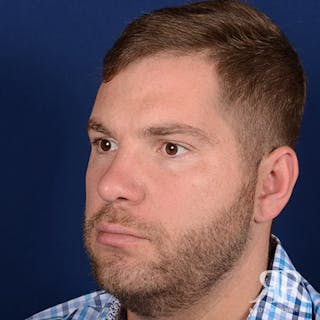 Male Rhinoplasty Before & After Gallery - Patient 320524 - Image 4