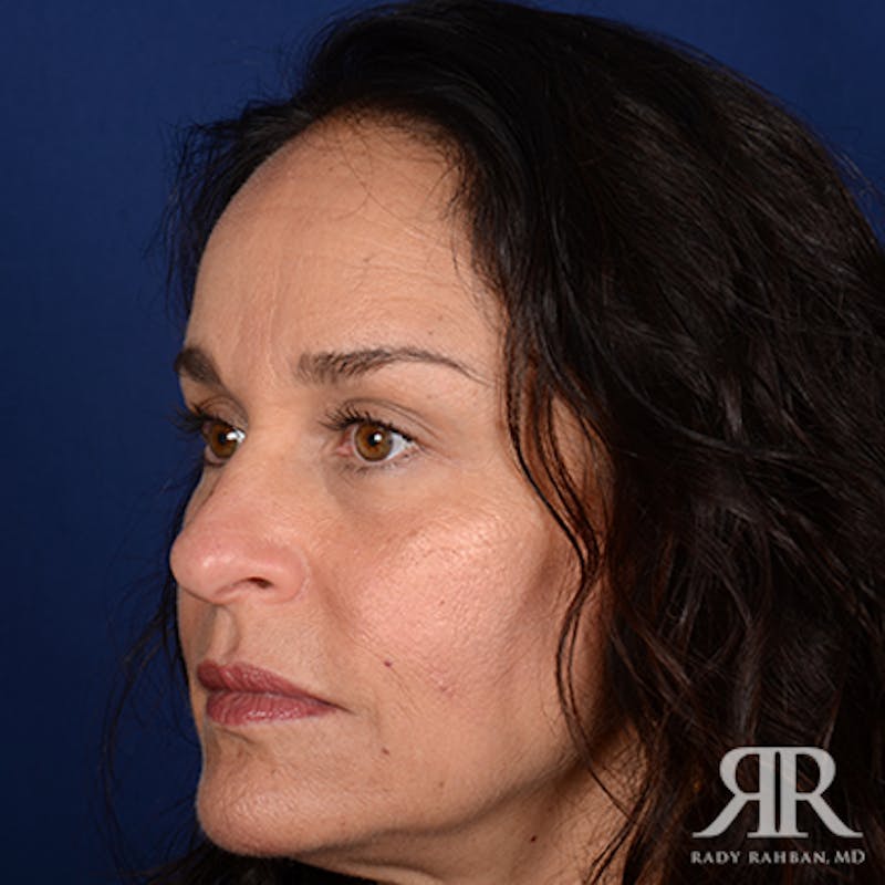Female Rhinoplasty Before & After Gallery - Patient 205526 - Image 3