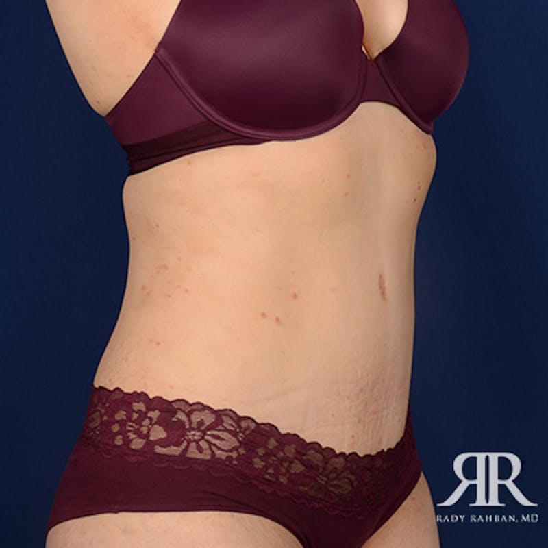 Tummy Tuck Before & After Gallery - Patient 210096 - Image 4