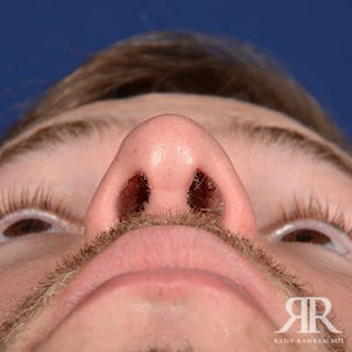 Male Rhinoplasty Before & After Gallery - Patient 320524 - Image 8