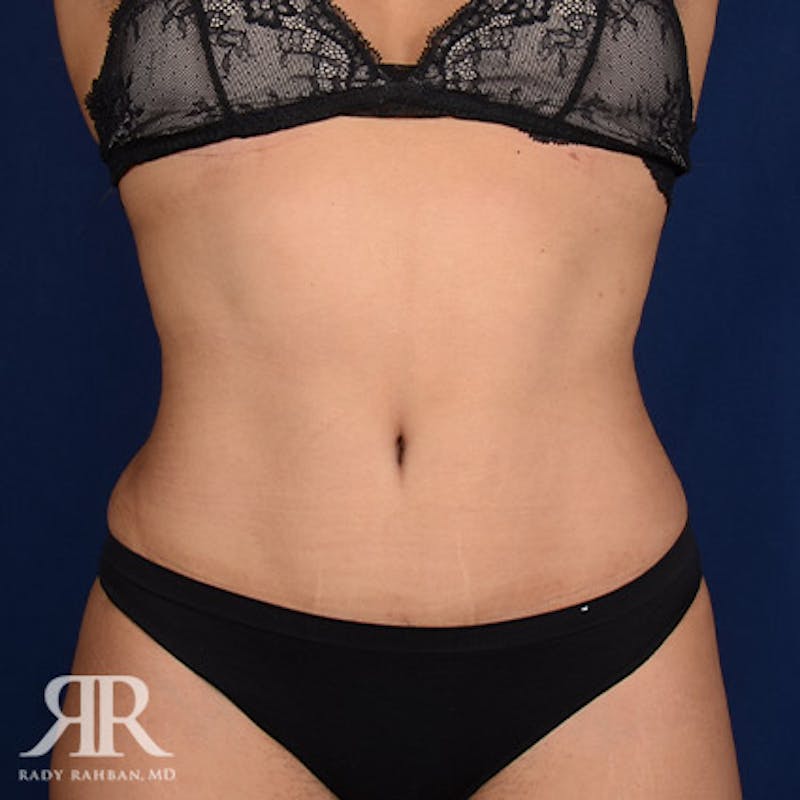 Tummy Tuck Before & After Gallery - Patient 383316 - Image 2