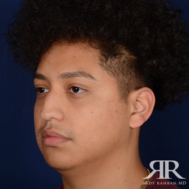 Male Rhinoplasty Before & After Gallery - Patient 671883 - Image 3