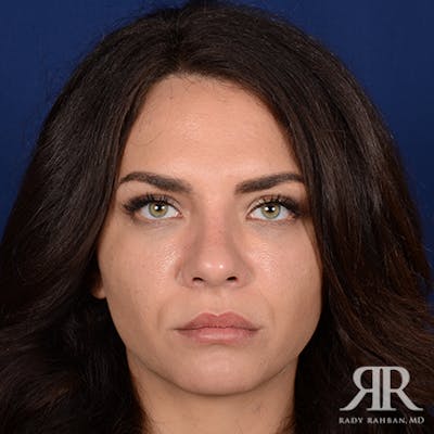 Female Rhinoplasty Before & After Gallery - Patient 317468 - Image 2