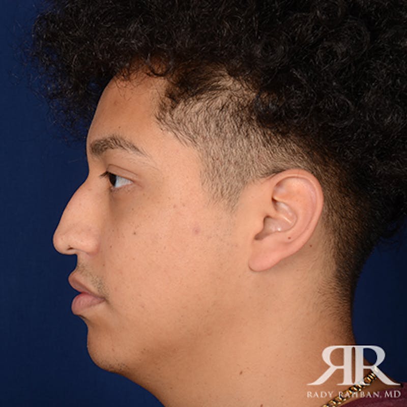 Male Rhinoplasty Before & After Gallery - Patient 671883 - Image 5