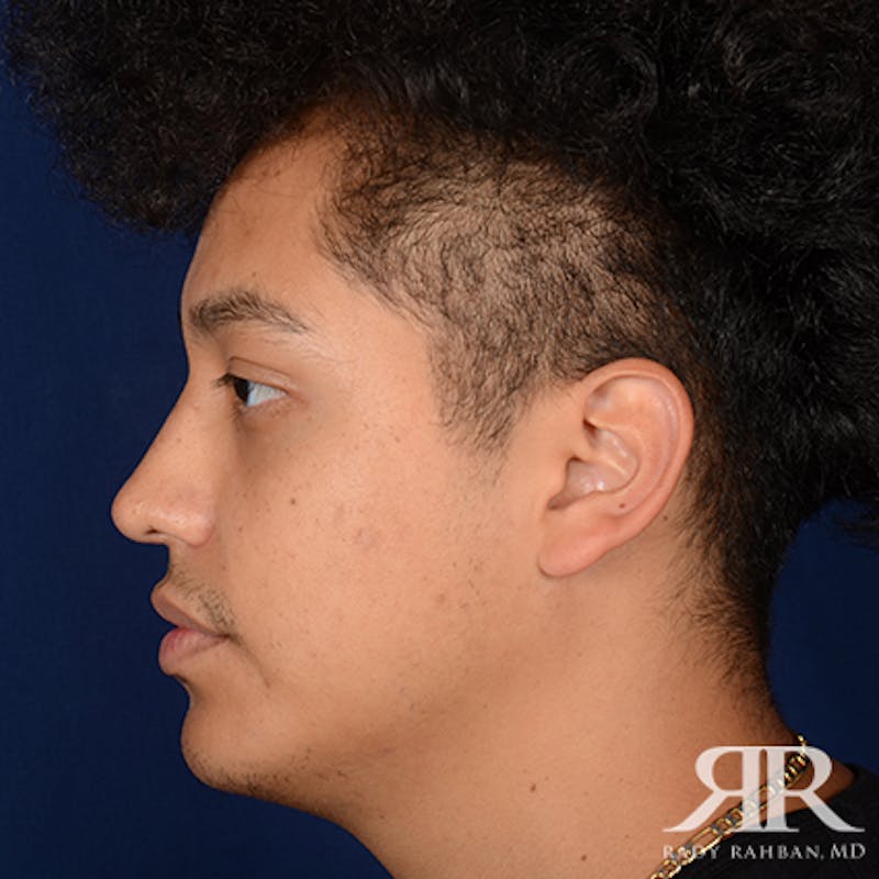Male Rhinoplasty Before & After Gallery - Patient 671883 - Image 6