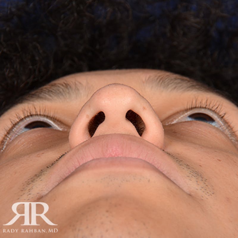 Male Rhinoplasty Before & After Gallery - Patient 671883 - Image 7